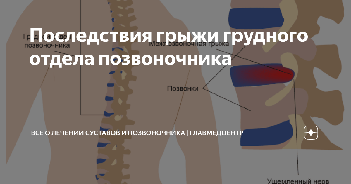 Обезболивающие таблетки при грыже поясницы