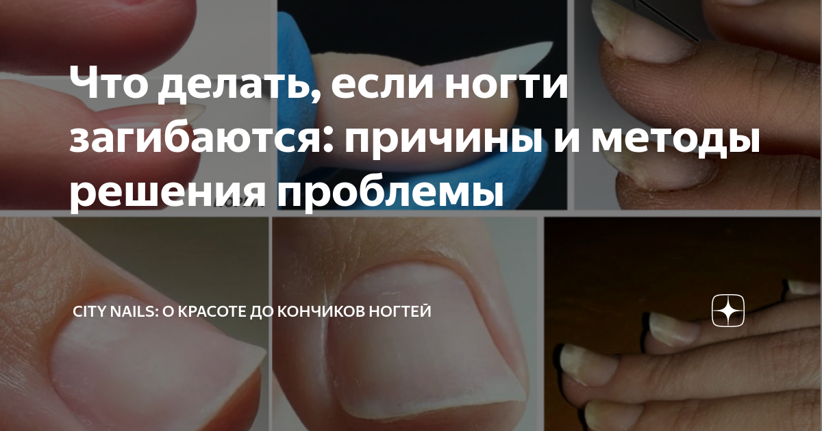 «Клюющие ногти». Почему ногти загибаются вниз и как с этим бороться