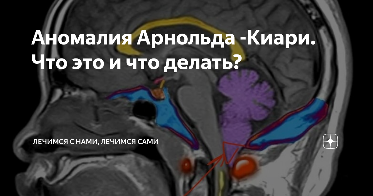 Аномалия арнольда киари мкб. Аномалия Арнольда Киари операция.