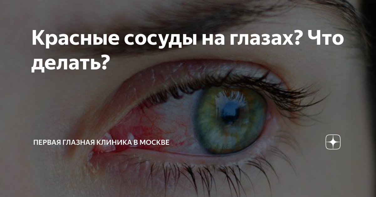 Красные сосуды на глазах? Что делать? | Первая глазная клиника в Москве ...