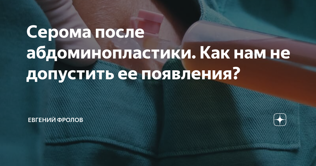 Серома после абдоминопластики. Как нам не допустить ее появления? Евгений Фролов