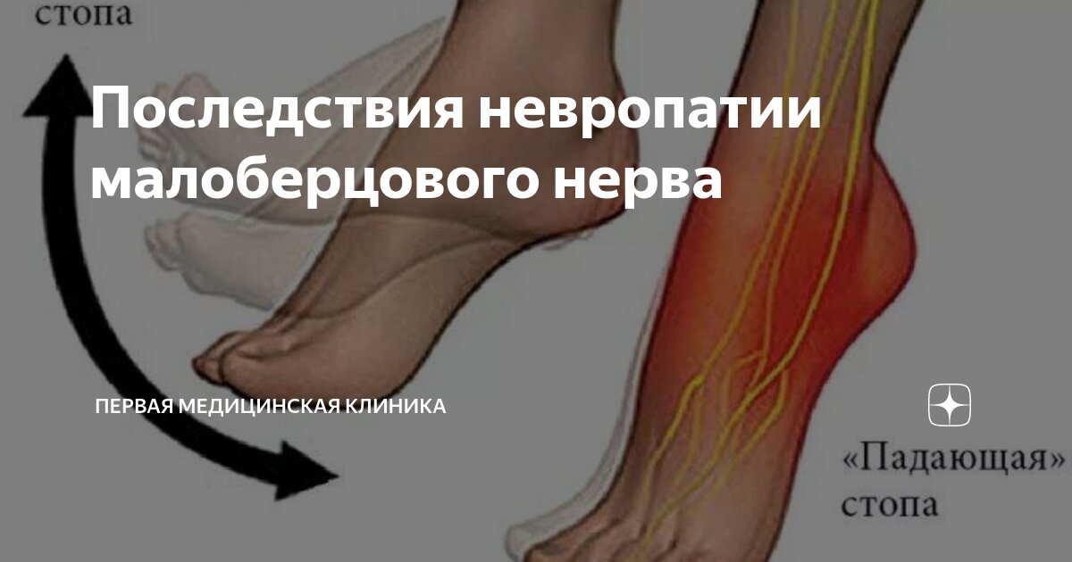Последствия невропатии малоберцового нерва | Первая Медицинская Клиника ...