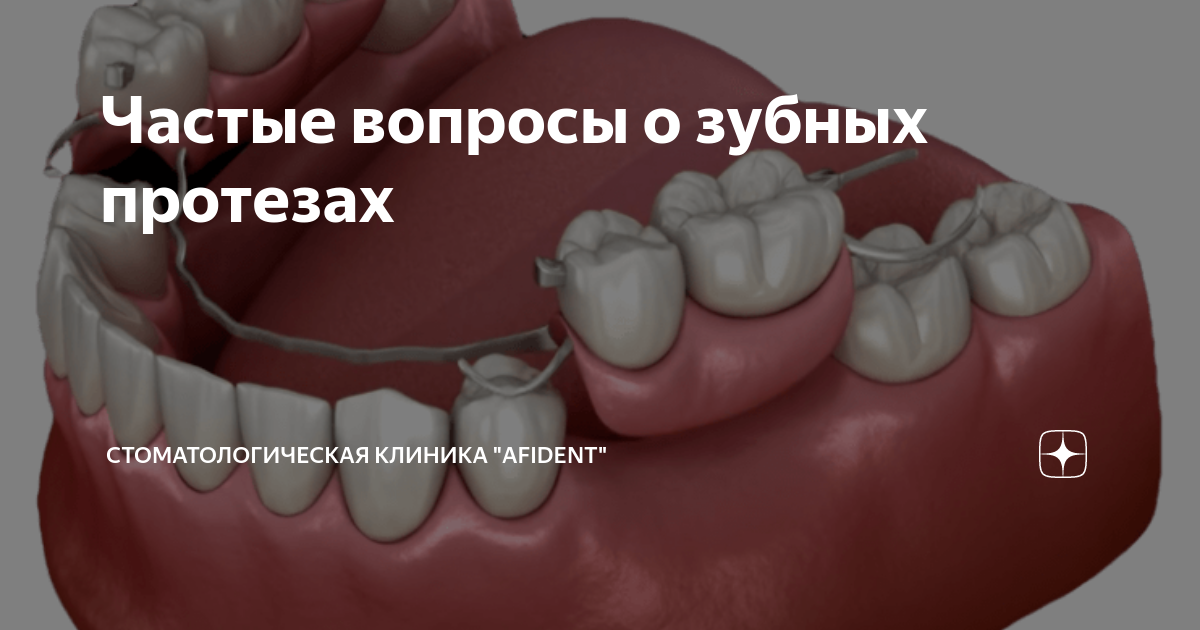 Частые вопросы о зубных протезах | Стоматологическая клиника AFIDENT | Дзен