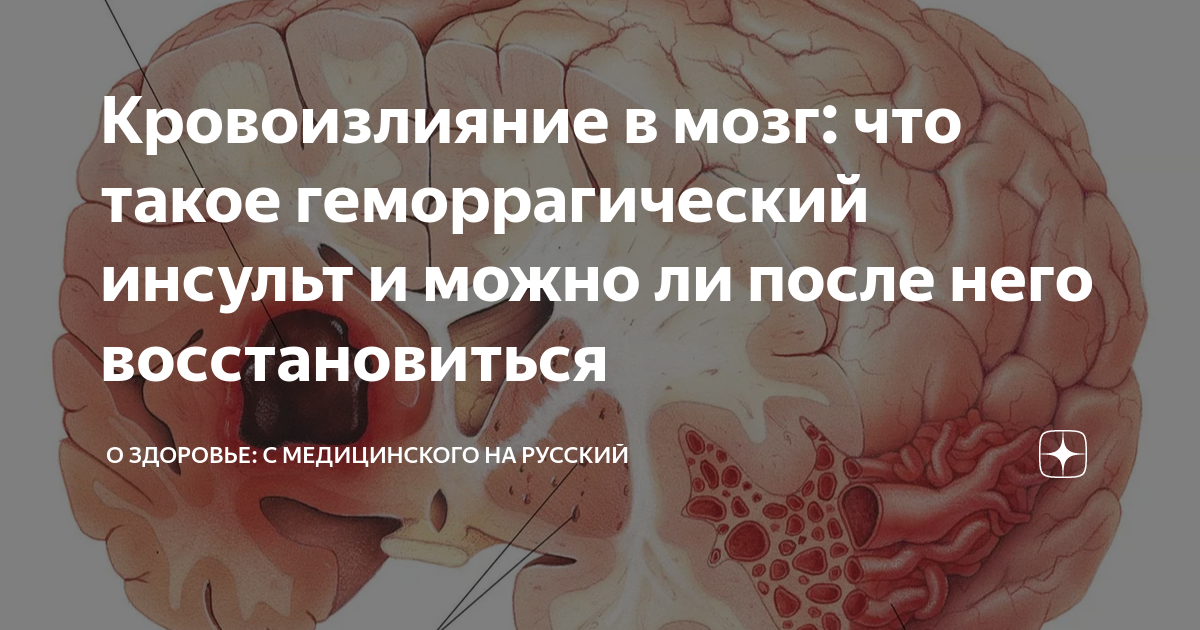 Прогноз кровоизлияния