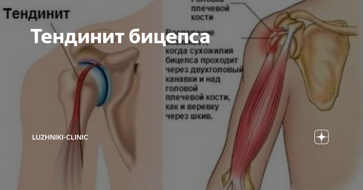 Признаки тендинопатии сухожилия