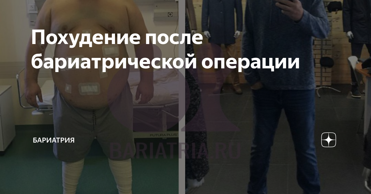 Бариаартрия до и после. Живот до и после похудения. До и после бариатрической операции. Похудел после операции. Похудел после операции.