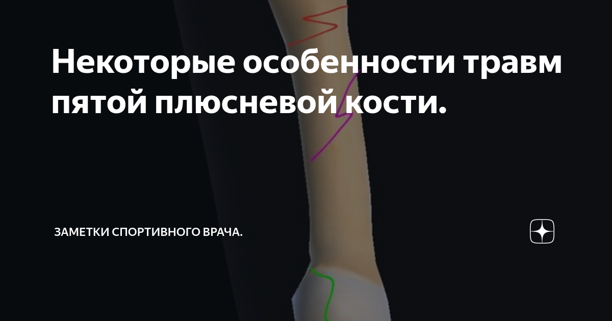 Некоторые особенности травм пятой плюсневой кости. | Заметки ...