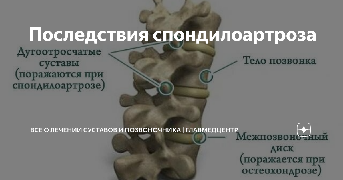 Что такое спондилоартроз?