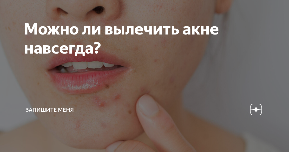 Можно ли вылечить акне навсегда? | Запишите меня | Дзен