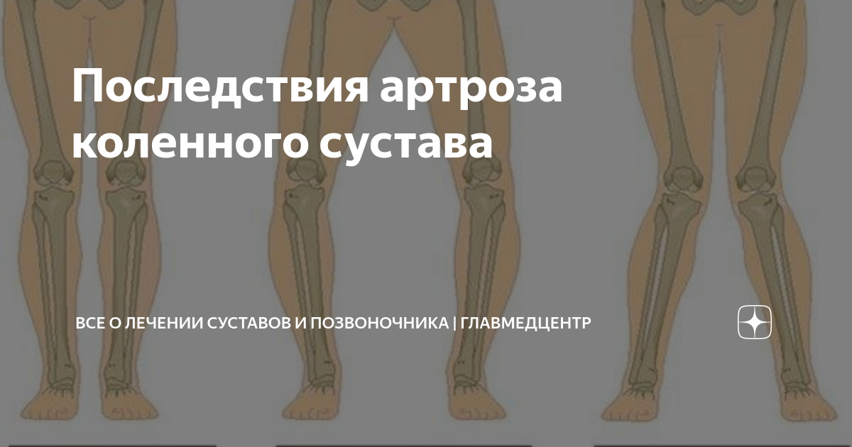 Последствия артроза коленного сустава | Все о лечении суставов и ...