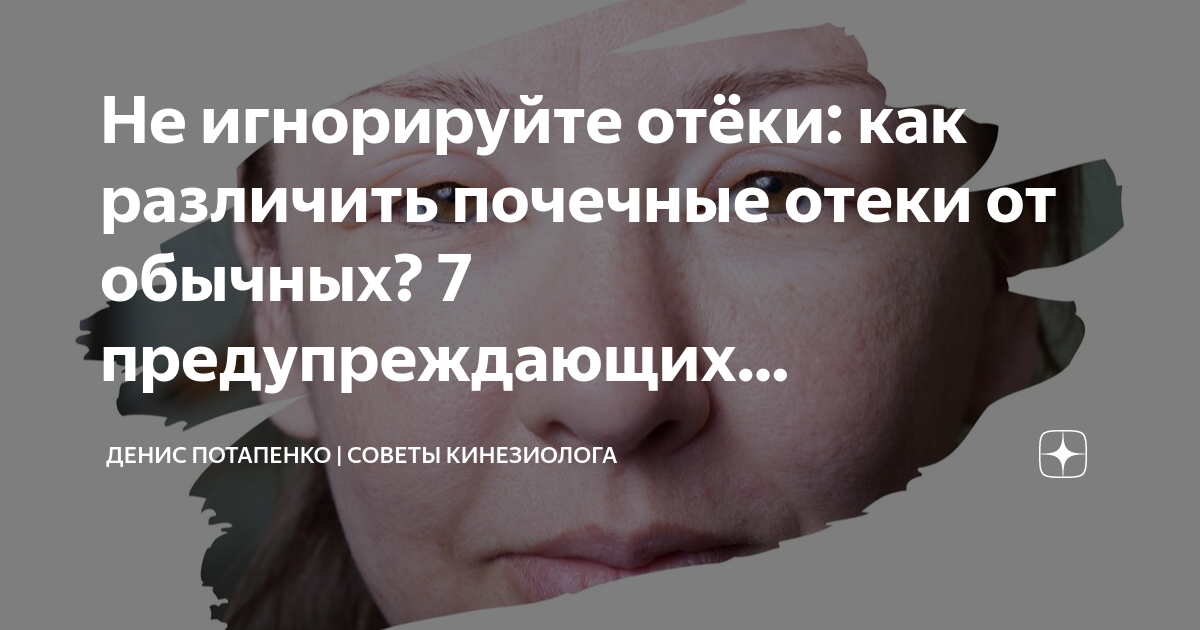 Не игнорируйте отёки: как различить почечные отеки от обычных? 7 ...