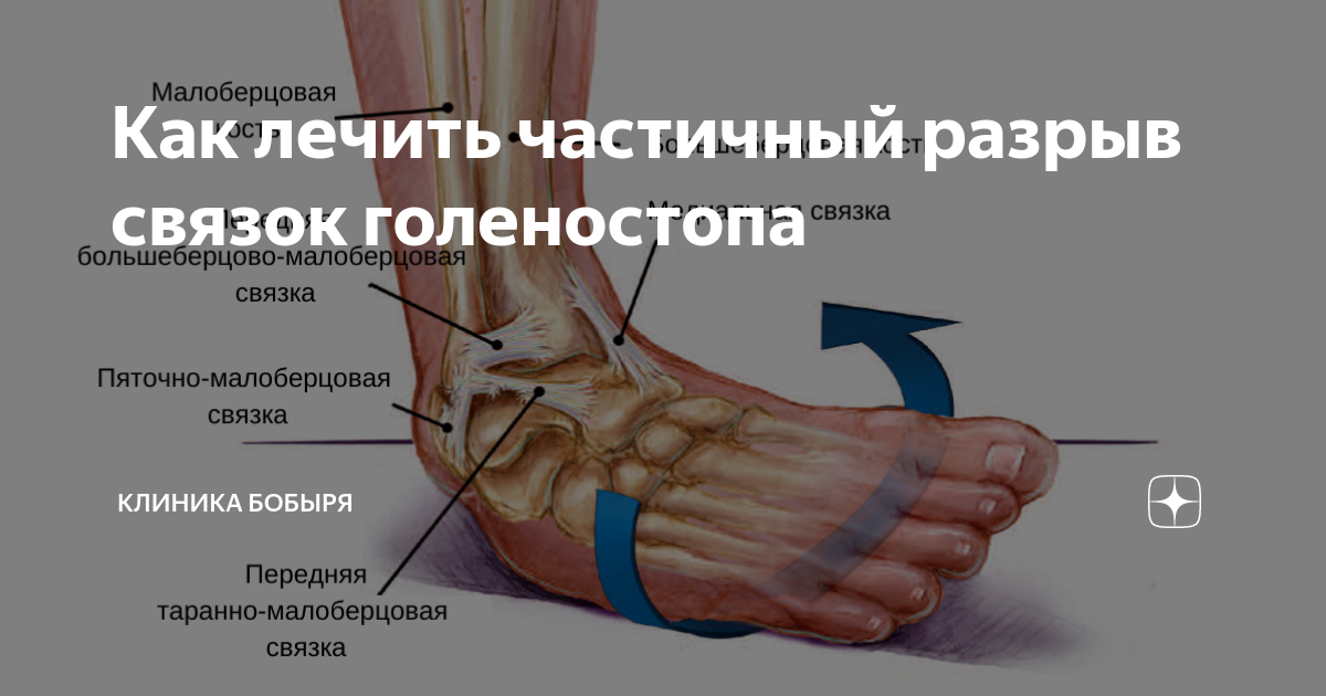 Разрыв связок голеностопного сустава фото симптомы