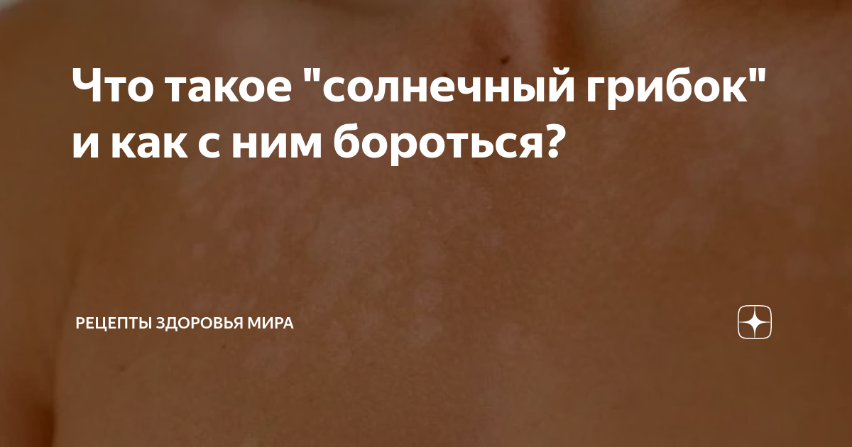 Что такое "солнечный грибок" и как с ним бороться? | Рецепты здоровья ...