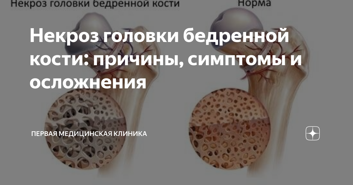 Некроз головки бедренной кости: причины, симптомы и осложнения | Первая ...