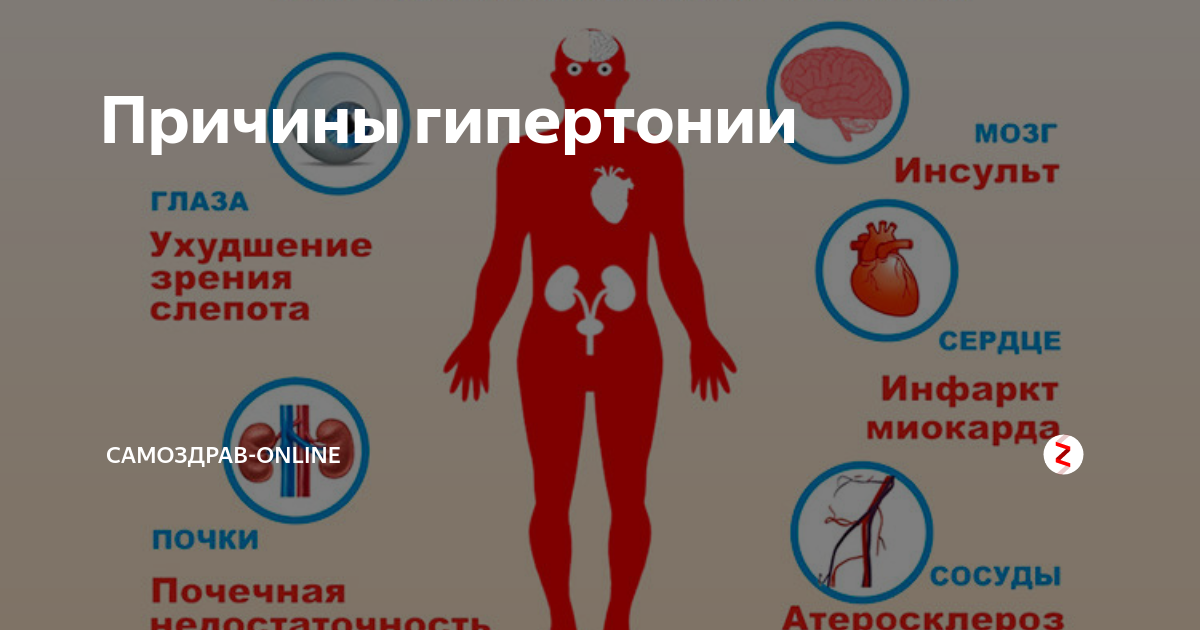 Причины гипертензии Причины гипертензии