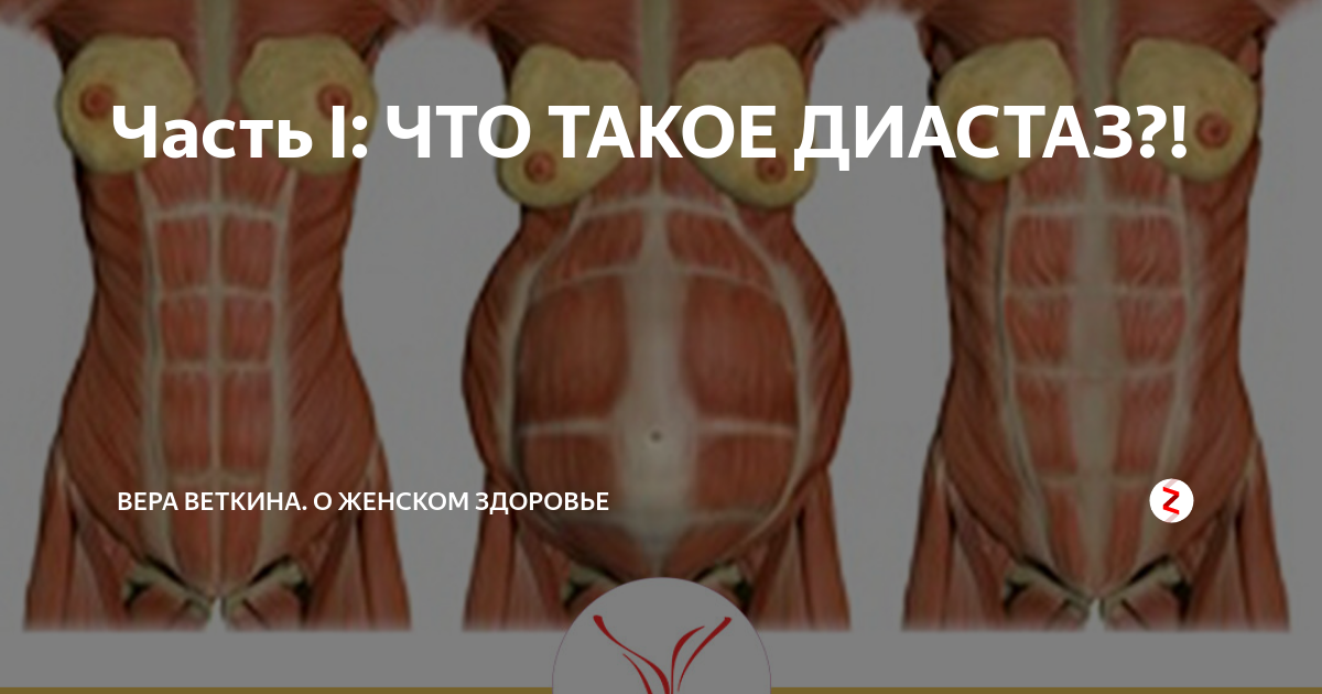 Диастаз - это слабость и растяжение белой линии прямой мышцы живота (то есть сое