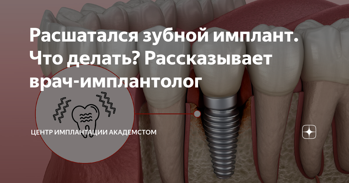 Все о боли после установки имплантов зубов — что болит, сколько дней длится боль, как ее уменьшить