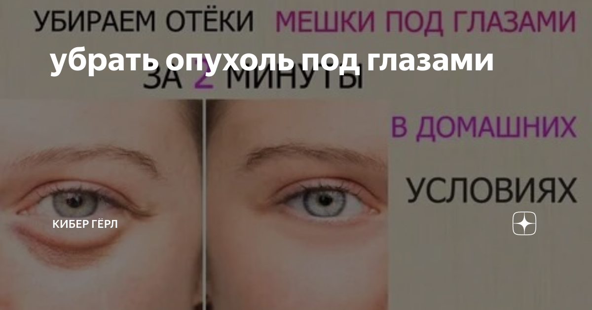 Как снять отеки под глазами быстро ОТЕКИ И МЕШКИ под глазами Убираем за 30 минут, быстро и просто #112 Gesundheit,