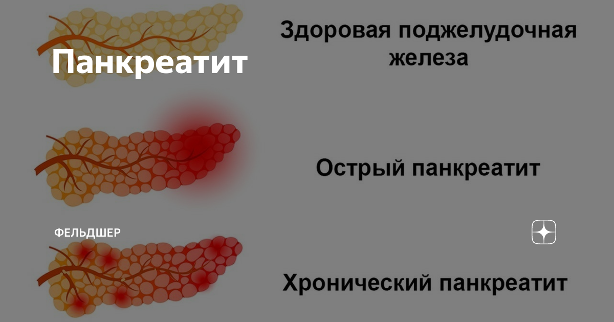 можно ли есть тунец при панкреатите
