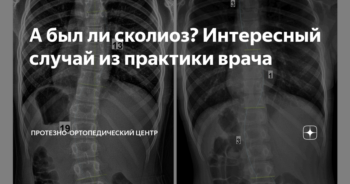 А был ли сколиоз? Интересный случай из практики врача | Протезно ...