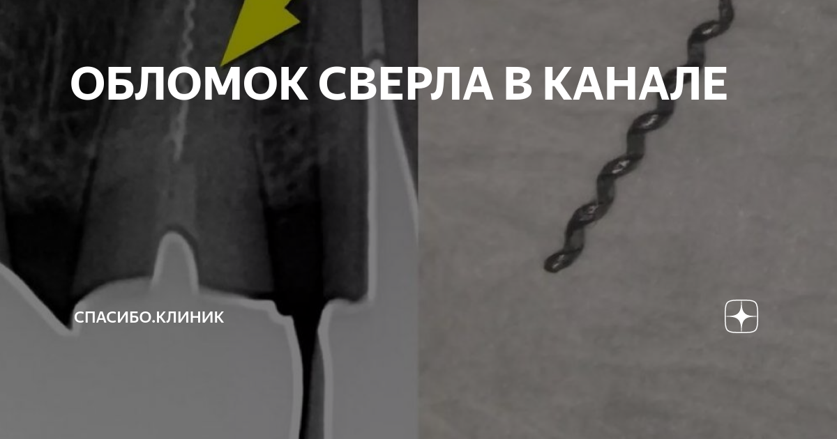 ОБЛОМОК СВЕРЛА В КАНАЛЕ | Спасибо.Клиник | Дзен