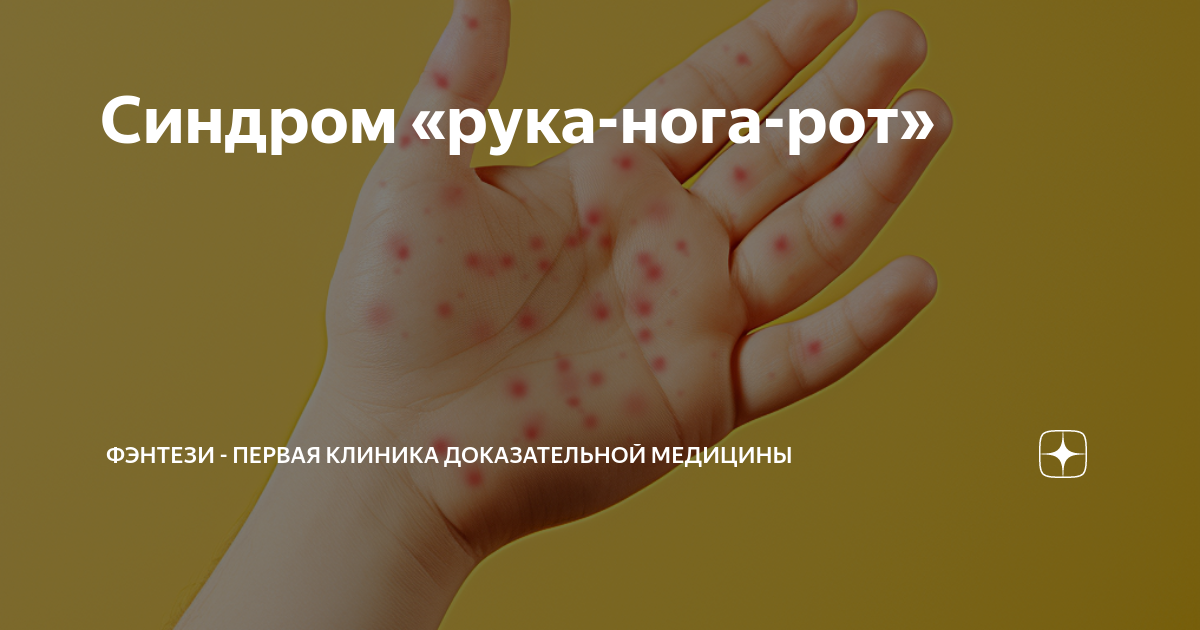 рука нога рот у детей симптомы