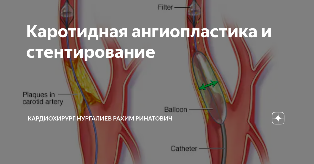 Диагностика атеросклероза сонных артерий