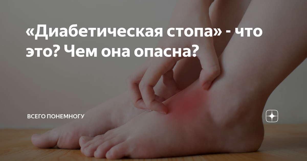 «Диабетическая стопа» - что это? Чем она опасна? | Всего понемногу: о ...