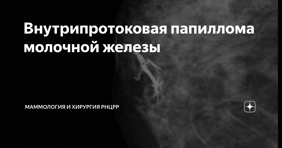 Внутрипротоковая папиллома молочной железы операция Внутрипротоковая папиллома молочной железы операция