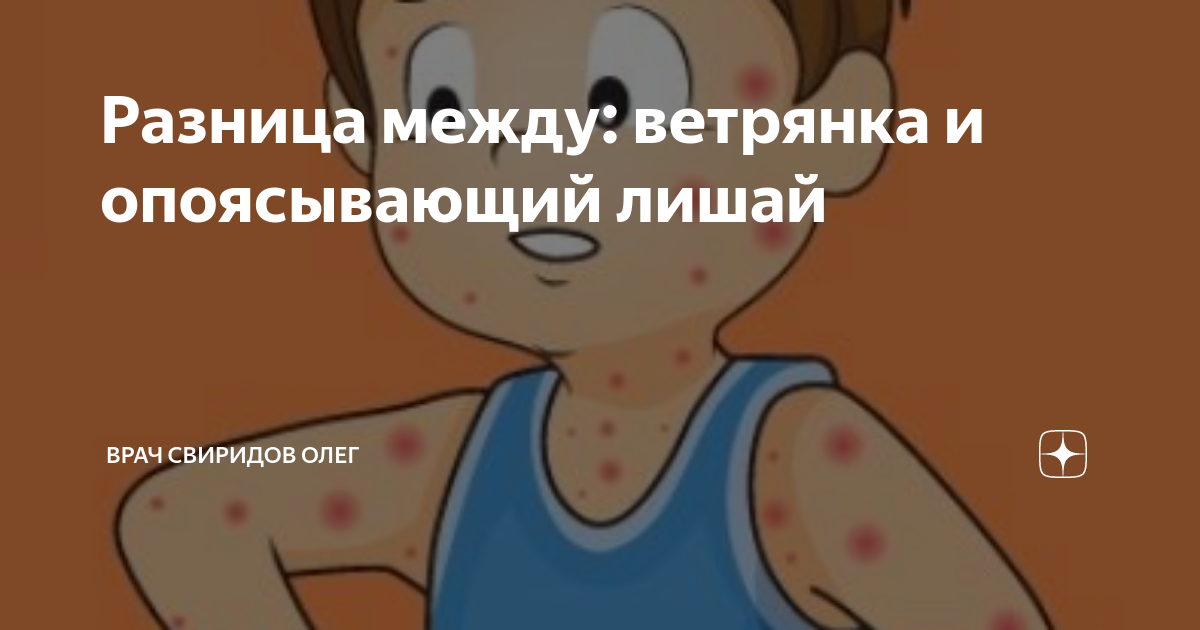 Разница между: ветрянка и опоясывающий лишай | Врач Свиридов Олег | Дзен