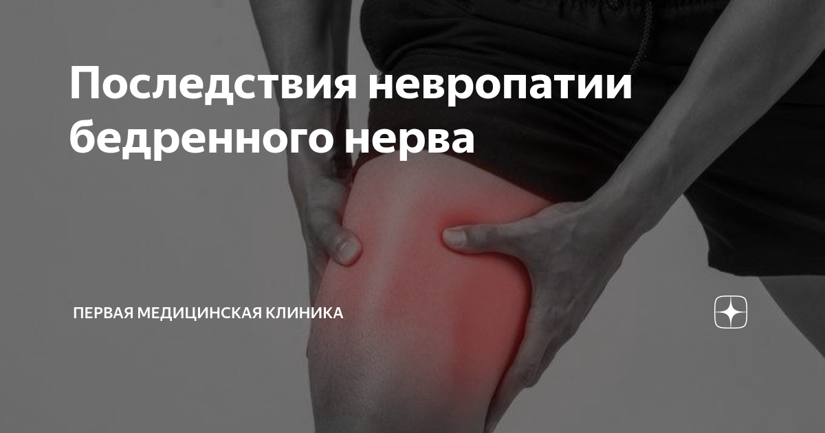 Последствия невропатии бедренного нерва | Первая Медицинская Клиника | Дзен