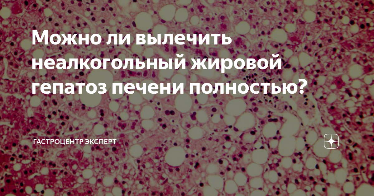 Можно ли вылечить неалкогольный жировой гепатоз печени полностью ...