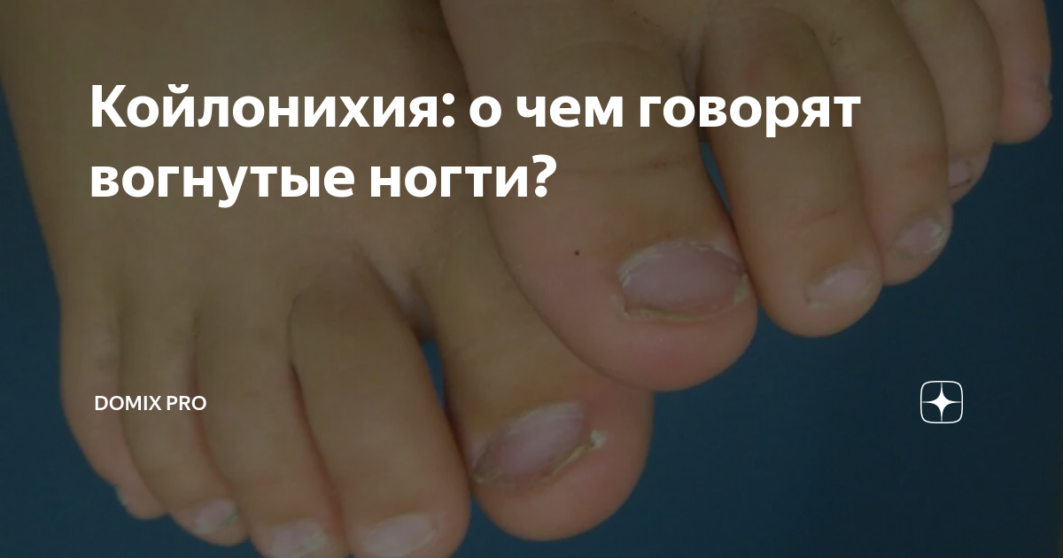 Койлонихия: о чем говорят вогнутые ногти? | Domix pro | Дзен