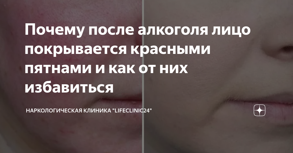 Зуд и сыпь после алкоголя: причины, последствия, что делать