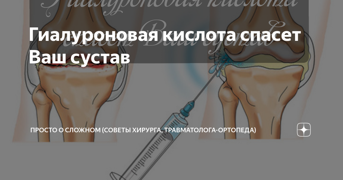 Гиалуроновая кислота спасет Ваш сустав | Просто о сложном (советы ...