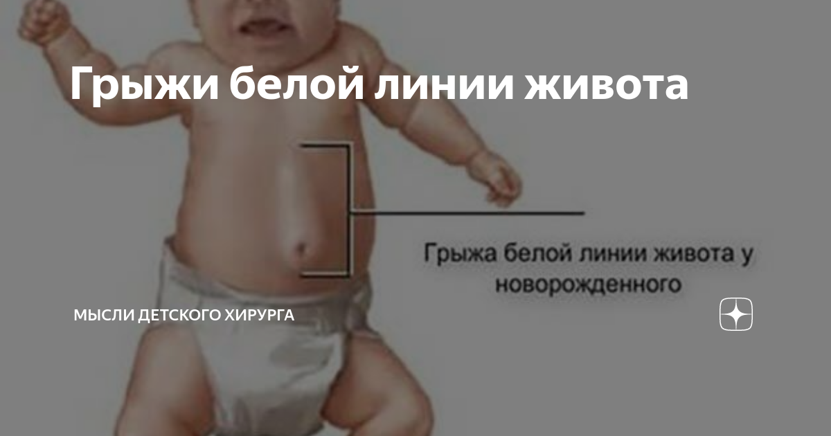Как выглядит грыжа белой линии Грыжа белой линии живота у ребенка: основные аспекты, рекомендации врачей и мето