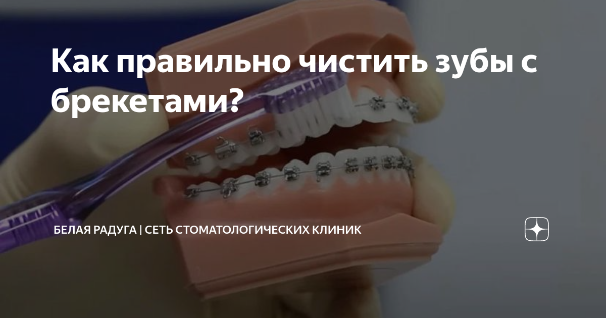 как делают проф чистку зубов с брекетами
