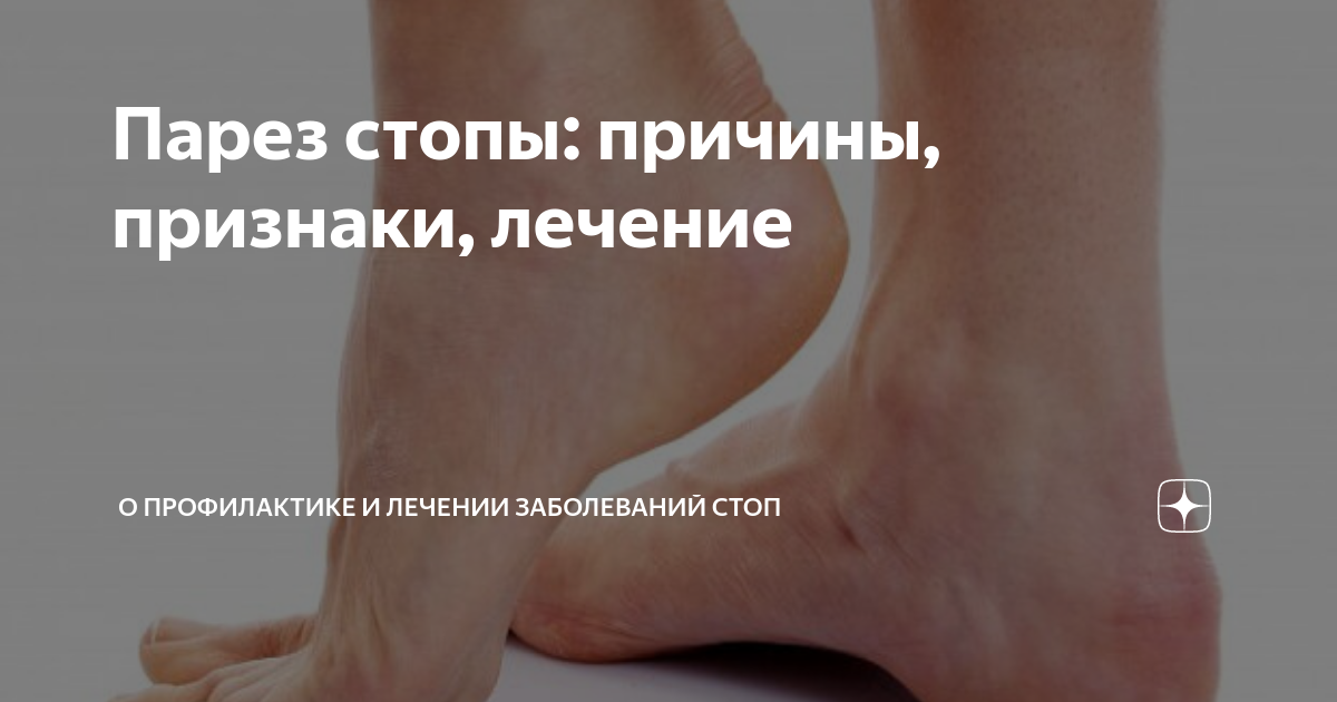 Парез стопы: причины, признаки, лечение | Формтотикс | Индивидуальные ...