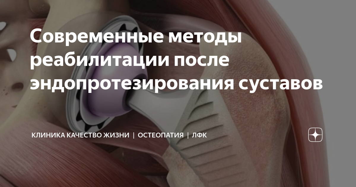 Реабилитация эндопротеза тазобедренного сустава. Реабилитация при эндопротезировании тазобедренного сустава. Рекомендации пациентам, перенесшим эндопротезирование тазобедренного. Эндопротезирование тазобедренного сустава. Загородний