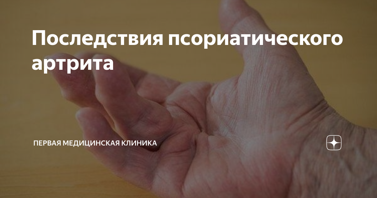 Последствия псориатического артрита | Первая Медицинская Клиника | Дзен