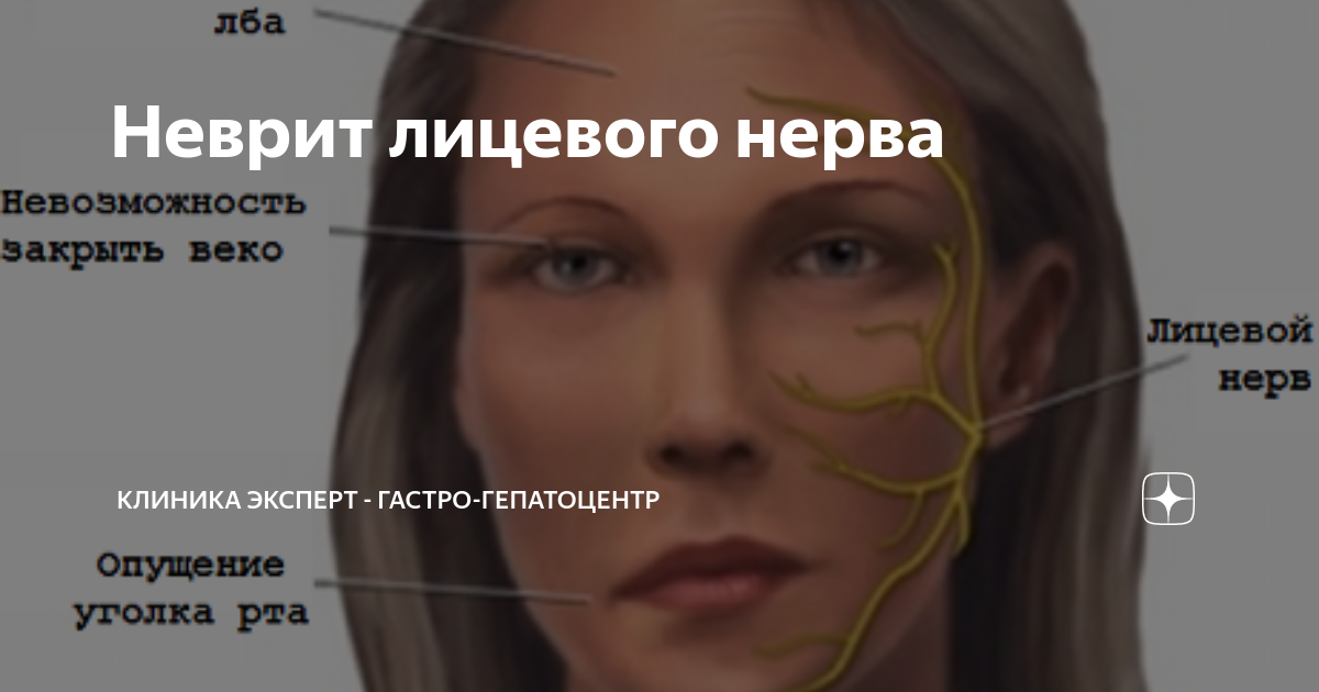 Неврит лицевого нерва мкб 10 код. Поражение лицевого нерва клиники Москва.
