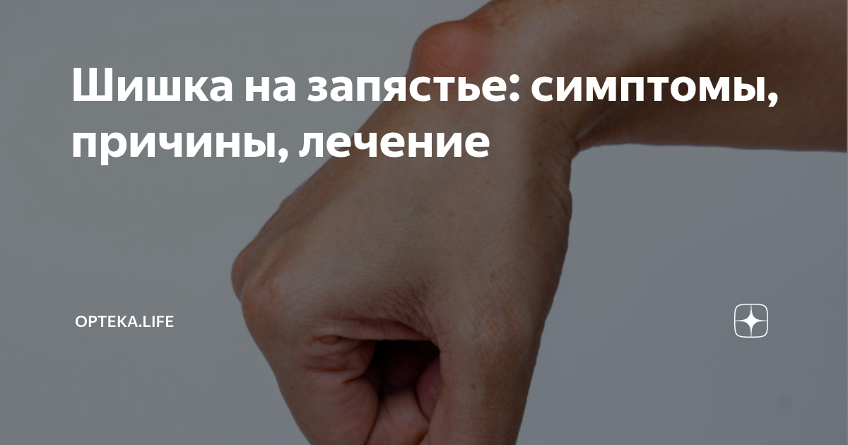 Шишка на запястье: симптомы, причины, лечение | ОРТЕКА.Life | Дзен