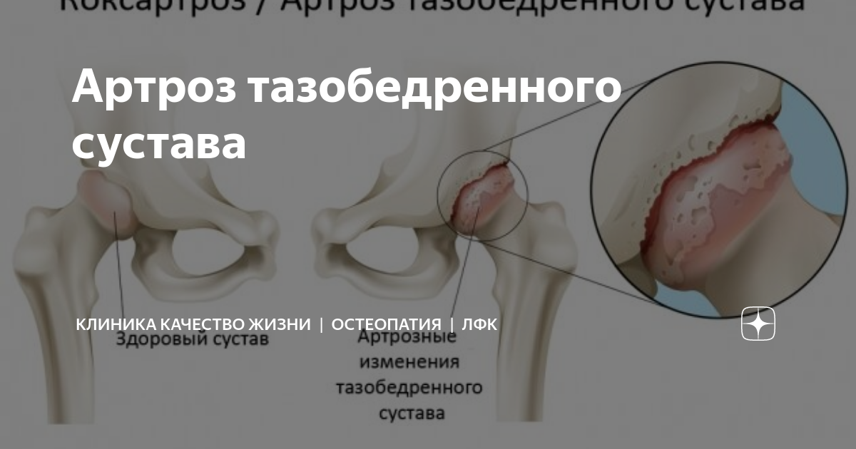Лфк тазабедренный сустав. Упражнения после эндопротезирования тазобедренного сустава дома. Тазобедренный сустав - ранняя диагностика, причины, профилактика и лечение Как лечить или убрать боль в тазобедренном суставе