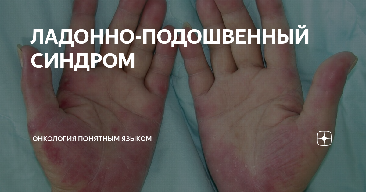 ЛАДОННО-ПОДОШВЕННЫЙ СИНДРОМ | Онкология понятным языком. Доктор ...