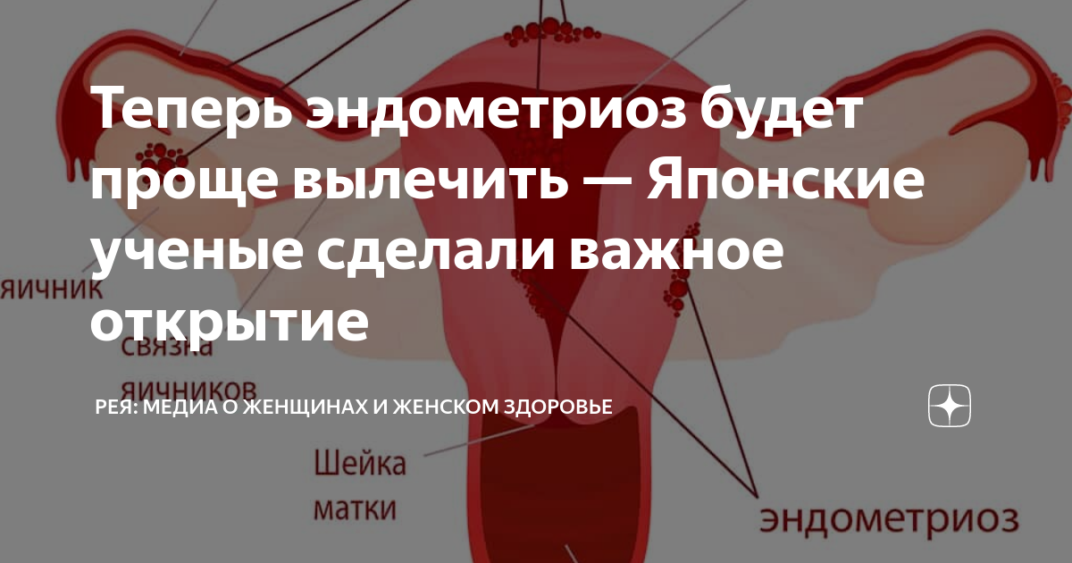 Теперь эндометриоз будет проще вылечить — Японские ученые сделали ...