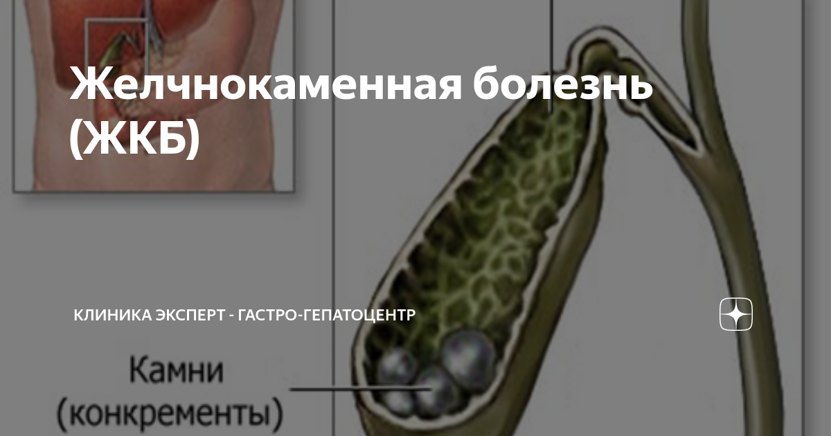 желчнокаменная болезнь мкб