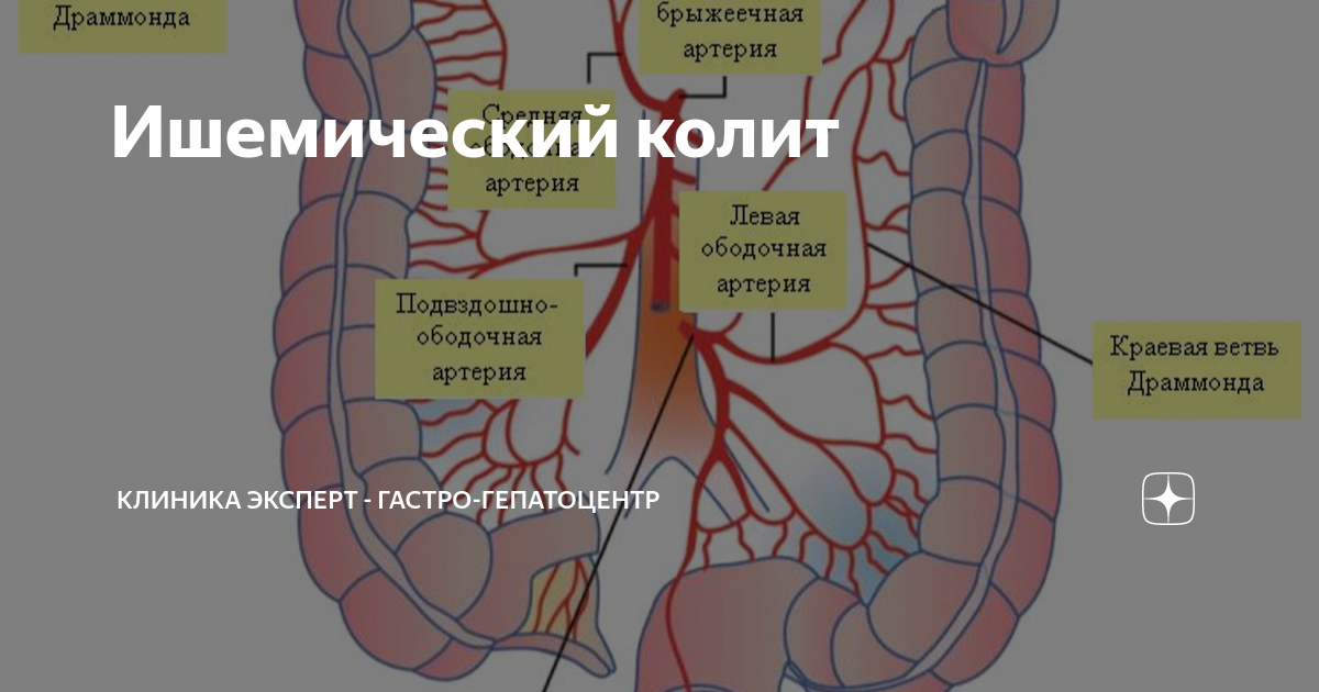 Ишемический колит | Клиника ЭКСПЕРТ - Гастро-гепатоцентр | Дзен