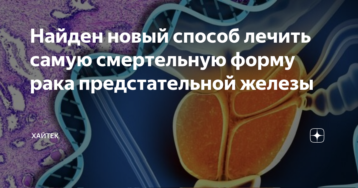 Найден новый способ лечить самую смертельную форму рака предстательной ...