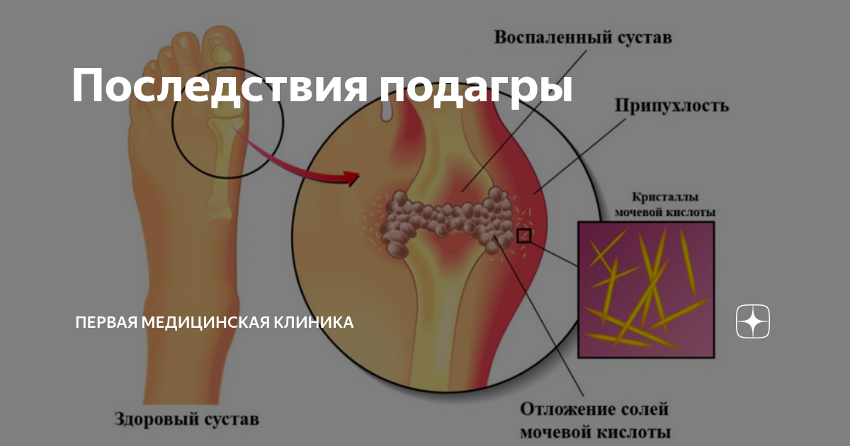 Последствия подагры | Первая Медицинская Клиника | Дзен