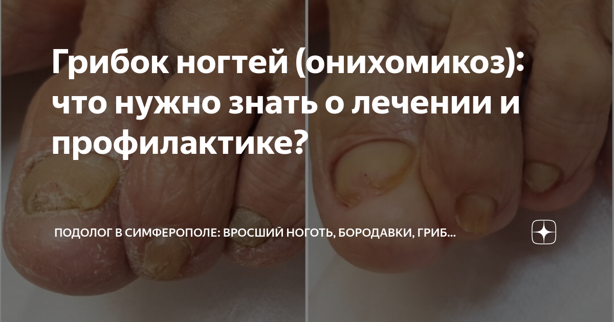Грибок ногтей (онихомикоз): что нужно знать о лечении и профилактике ...